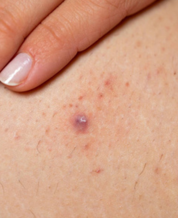 什么原因引起毛囊炎的，带图看毛囊炎真相，实拍毛囊炎配文原因分析（一文毛囊炎大全）