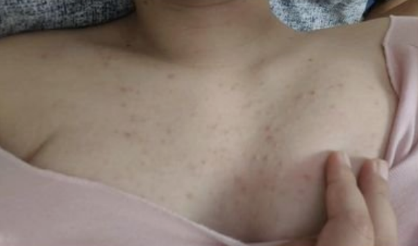胸口上的痘痘-是上火还是青春痘还是毛囊炎~症状照片参考