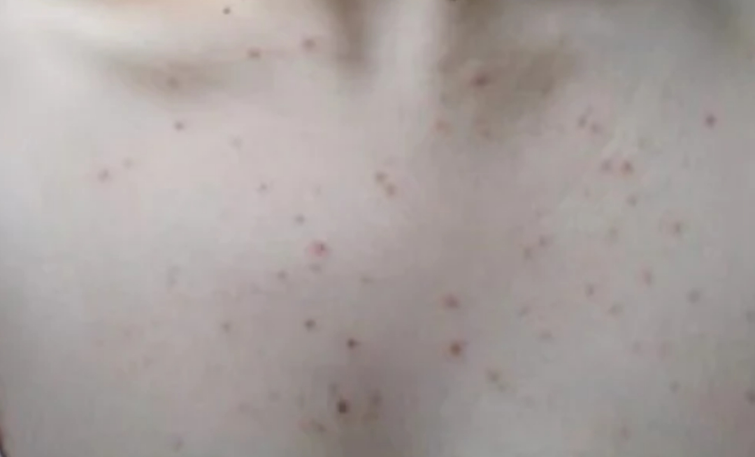 怎么消除毛囊炎硬疙瘩？“小窍门”王牌医生来这样教你使用药