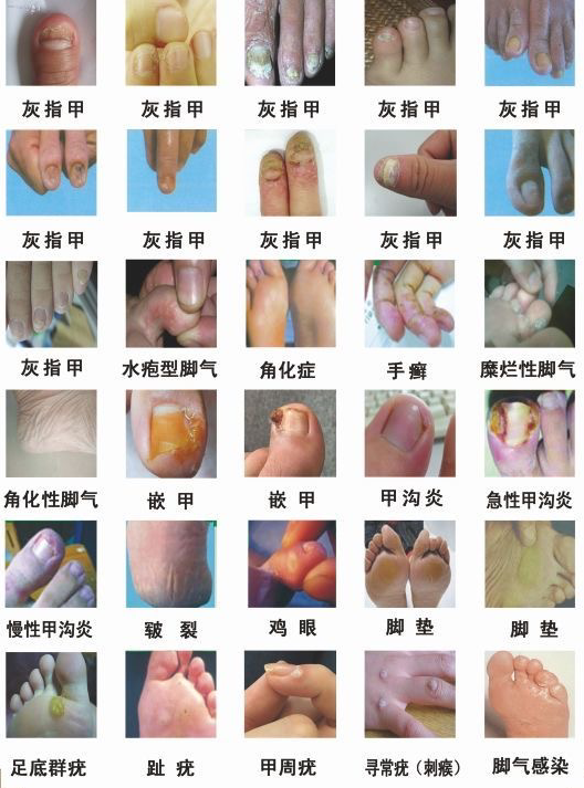 皮肤病图普→百全皮肤病图片识别↔100多种种皮肤病照片大全(增加版)