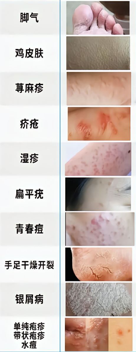皮肤病自查图#100种皮肤病对照图~皮肤病自测拍照