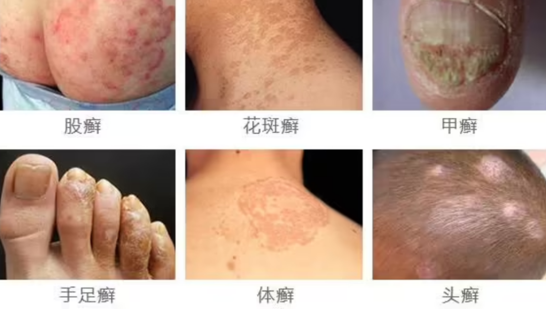 股癣，花斑癣，甲癣，手足癣，体癣，头癣6种癣图片大全要分清楚了“症状是不一样的”仔细看