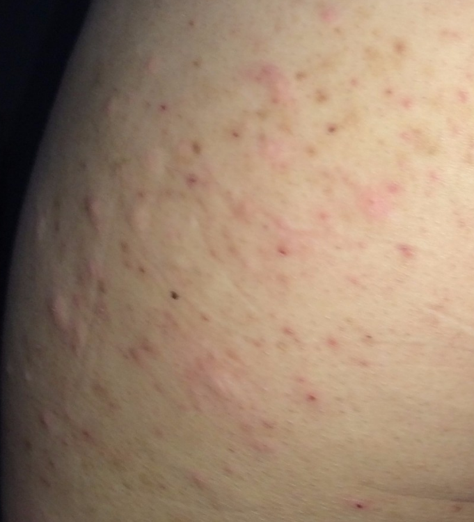 毛囊炎总是长，让人真是烦人“不用在被毛囊炎困扰了”治疗毛囊炎的办法来了