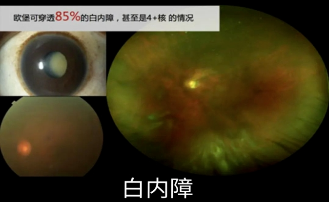 眼底激光机有什么牌子眼底一张照，眼病早知道——首大眼科中心引进欧堡新一代超广角激光扫描检眼镜！_https://www.jmylbn.com_新闻资讯_第6张