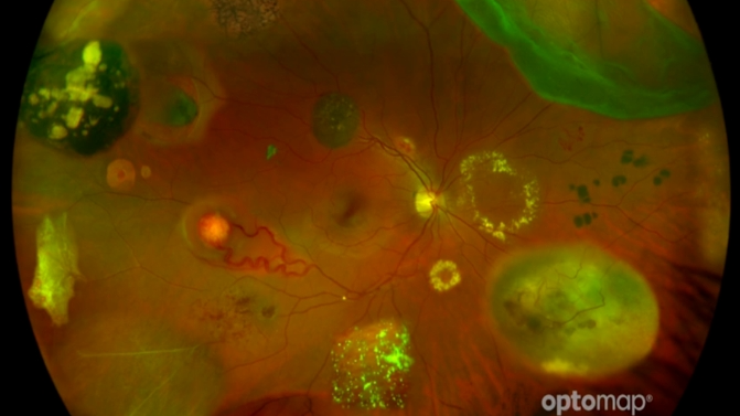 眼底激光机有什么牌子眼底一张照，眼病早知道——首大眼科中心引进欧堡新一代超广角激光扫描检眼镜！_https://www.jmylbn.com_新闻资讯_第5张