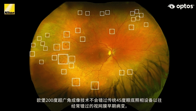 眼底激光机有什么牌子眼底一张照，眼病早知道——首大眼科中心引进欧堡新一代超广角激光扫描检眼镜！_https://www.jmylbn.com_新闻资讯_第4张