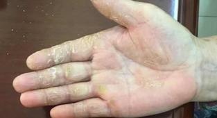 手足癣一定会痒吗？手足癣的类型有哪些？