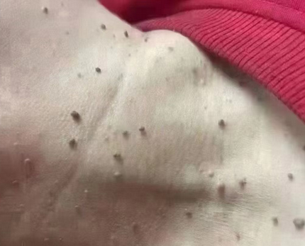刮匙是什么扁平疣VS丝状疣：皮肤上的“小疙瘩”到底有啥区别？_https://www.jmylbn.com_新闻资讯_第2张