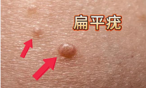 刮匙是什么扁平疣VS丝状疣：皮肤上的“小疙瘩”到底有啥区别？_https://www.jmylbn.com_新闻资讯_第1张
