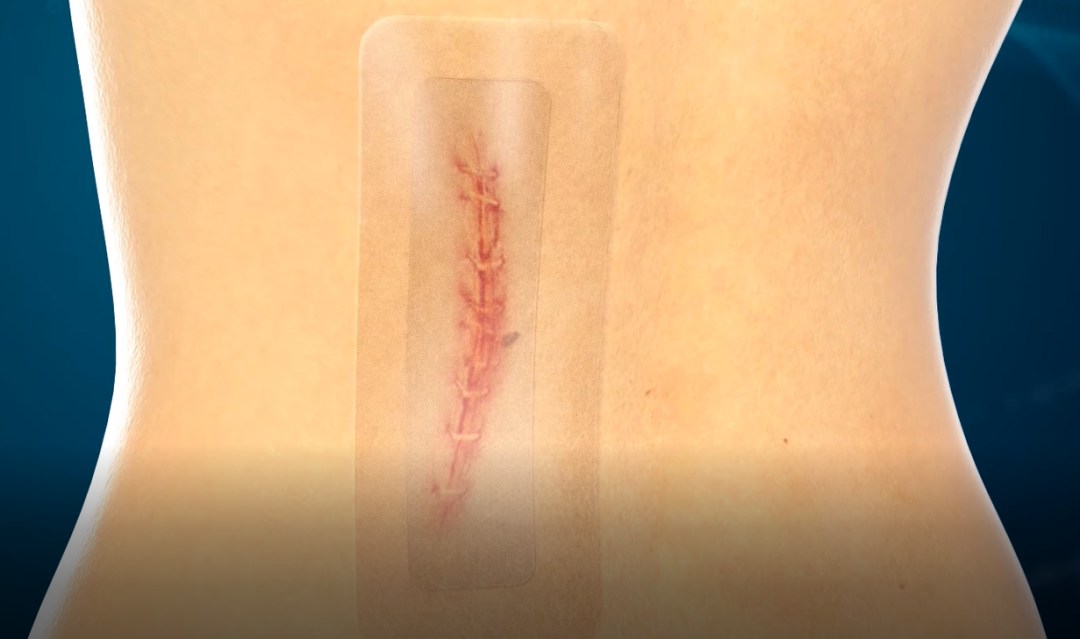 伤口凝胶敷料怎么储存防水透气+阻菌抑菌，水凝胶敷料双重保护创面_https://www.jmylbn.com_新闻资讯_第10张