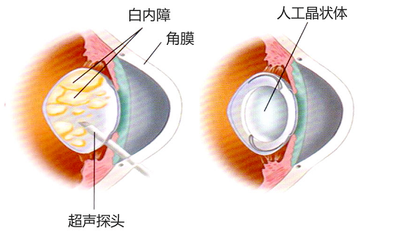 人工晶体产品是什么你了解人工晶状体吗？-上海聚慕医疗器械有限公司