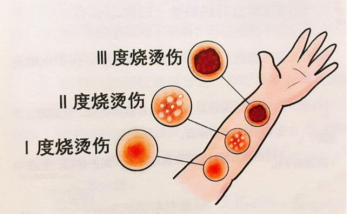 纱布怎么生产安全生产宣传月丨若遇意外烧烫伤，这些急救处理方法您一定要知道！_https://www.jmylbn.com_新闻资讯_第3张