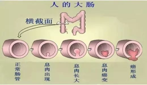什么是电凝钳夹【科室业务】什么是胃肠息肉？如何预防和治疗？看过来，一文搞懂胃肠息肉-上海聚慕医疗器械有限公司
