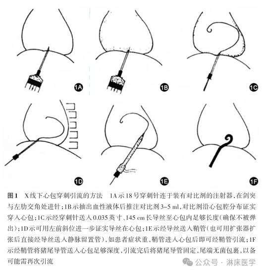 穿刺鞘英文怎么写《心房颤动导管射频消融技术规范》系列团体标准_https://www.jmylbn.com_新闻资讯_第17张