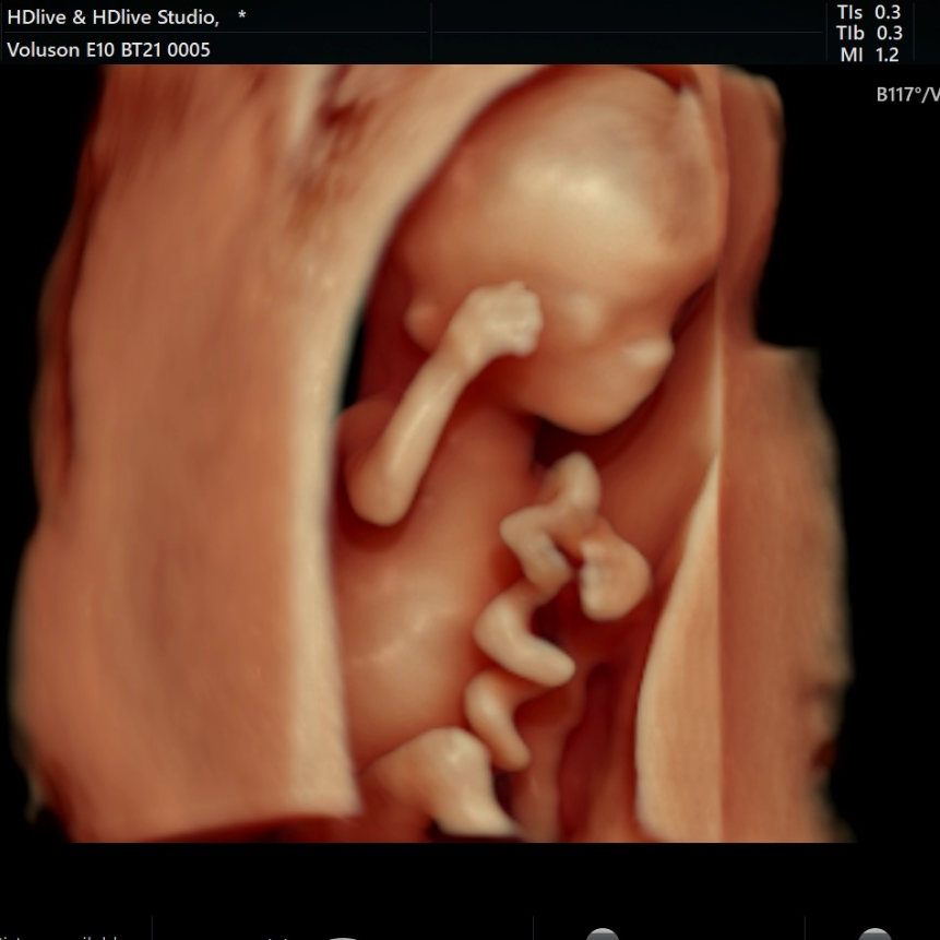 VOlusonE什么彩超机【重磅消息】准妈妈的福音！美国GE Voluson E10彩超进驻柳州二空医院啦！_https://www.jmylbn.com_新闻资讯_第5张