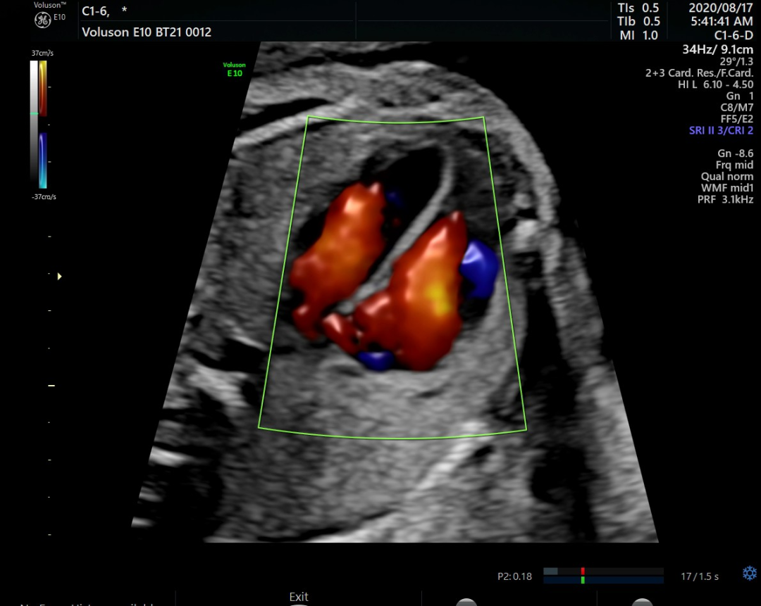 VOlusonE什么彩超机【重磅消息】准妈妈的福音！美国GE Voluson E10彩超进驻柳州二空医院啦！_https://www.jmylbn.com_新闻资讯_第8张