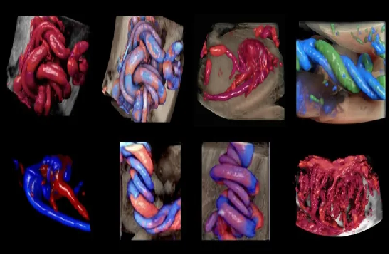 VOlusonE什么彩超机【重磅消息】准妈妈的福音！美国GE Voluson E10彩超进驻柳州二空医院啦！_https://www.jmylbn.com_新闻资讯_第13张