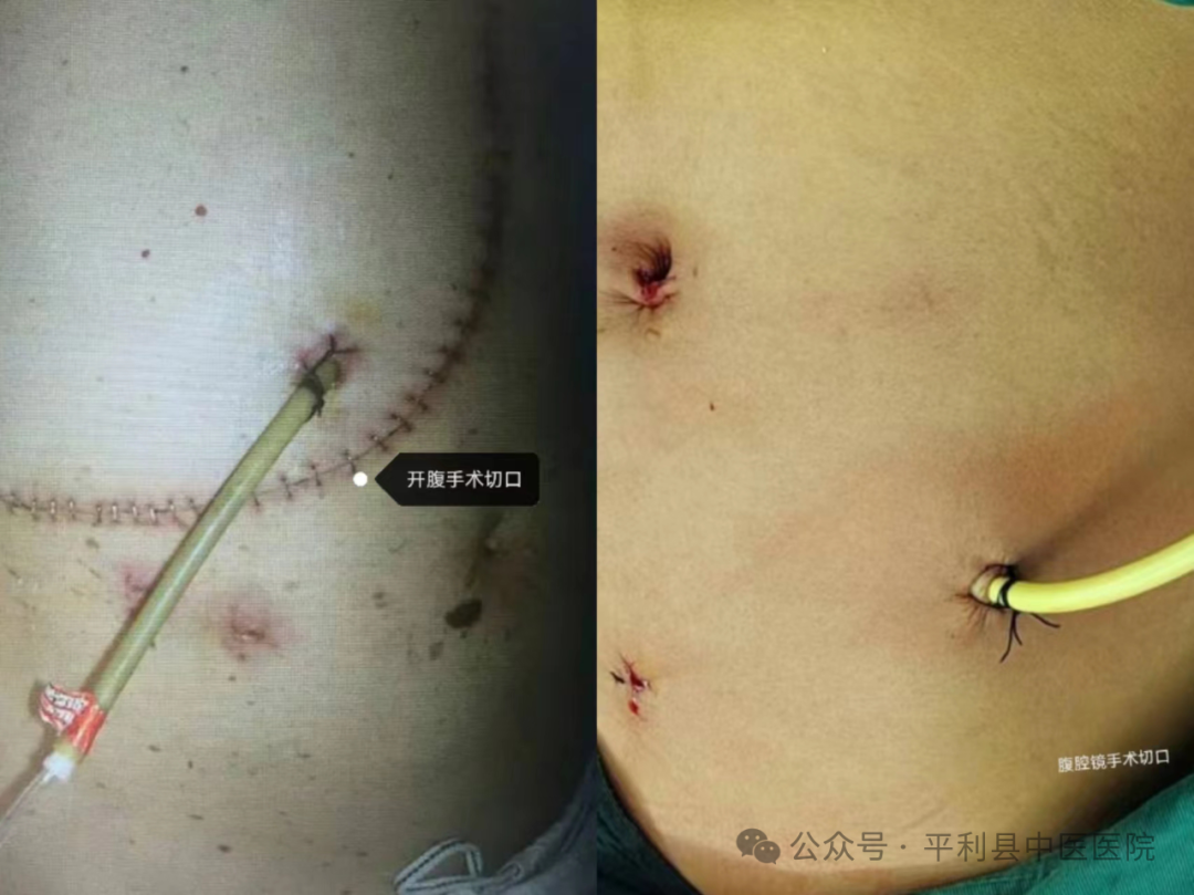 狼牌胆道镜怎么装“镜”无止境，平利县中医医院外二科新开展腹腔镜联合胆道镜下胆囊切除术+胆总管微创取石术_https://www.jmylbn.com_新闻资讯_第2张