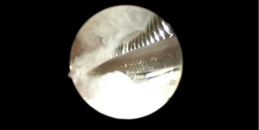 宫内镜怎么进入子宫【健康处方】带您了解“阴道内镜”_https://www.jmylbn.com_新闻资讯_第3张