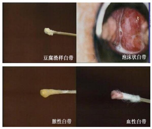 细菌性阴道病怎么检查【科普】什么是阴道炎联合检测_https://www.jmylbn.com_新闻资讯_第4张