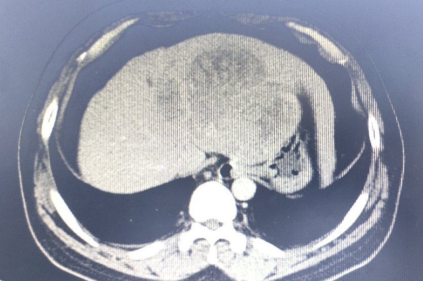 为什么要用到微导管精细介入  精准栓塞——微导管肝动脉灌注化疗栓塞术给肝癌患者带来希望！_https://www.jmylbn.com_新闻资讯_第1张