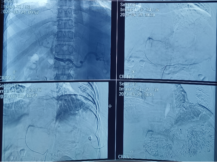 为什么要用到微导管精细介入  精准栓塞——微导管肝动脉灌注化疗栓塞术给肝癌患者带来希望！_https://www.jmylbn.com_新闻资讯_第2张