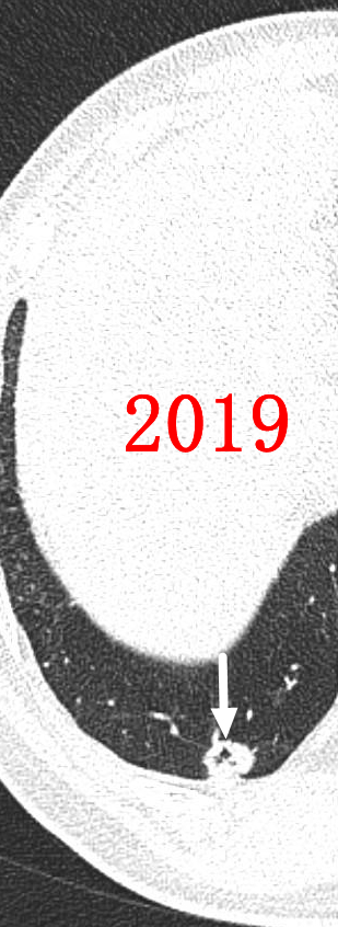 微波针是什么“针芯”化结——厦门市中医院首例CT引导下肺结节微波消融_https://www.jmylbn.com_新闻资讯_第4张