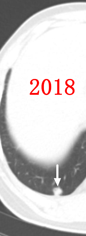 微波针是什么“针芯”化结——厦门市中医院首例CT引导下肺结节微波消融_https://www.jmylbn.com_新闻资讯_第3张