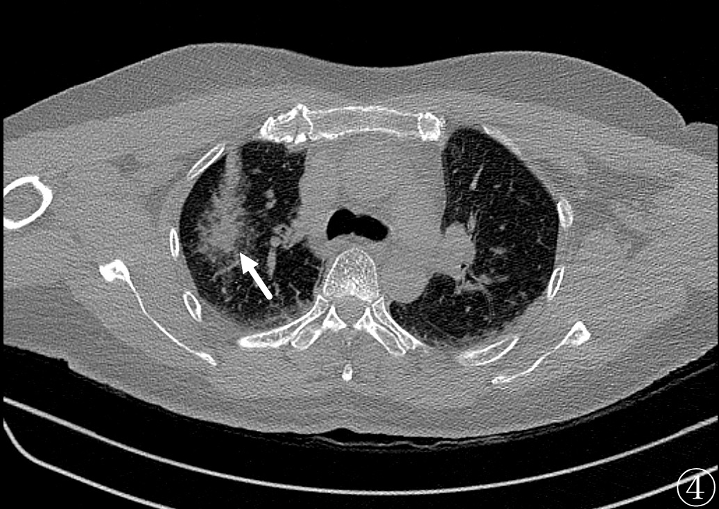 微波针是什么“针芯”化结——厦门市中医院首例CT引导下肺结节微波消融_https://www.jmylbn.com_新闻资讯_第9张