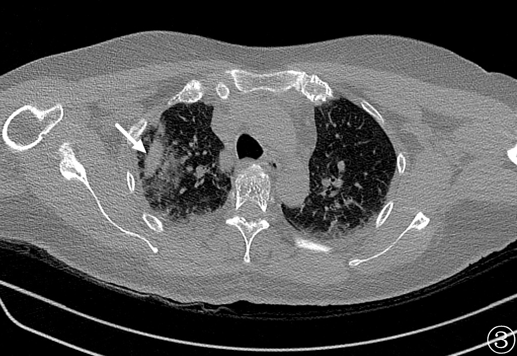 微波针是什么“针芯”化结——厦门市中医院首例CT引导下肺结节微波消融_https://www.jmylbn.com_新闻资讯_第8张