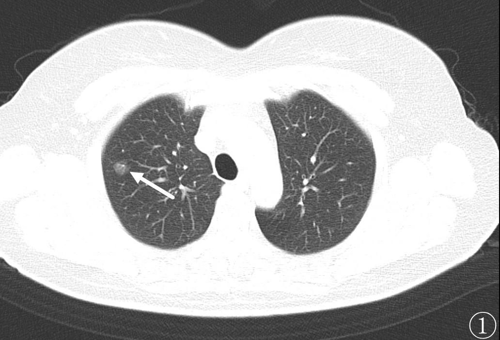 微波针是什么“针芯”化结——厦门市中医院首例CT引导下肺结节微波消融_https://www.jmylbn.com_新闻资讯_第6张