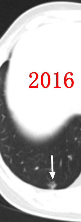 微波针是什么“针芯”化结——厦门市中医院首例CT引导下肺结节微波消融_https://www.jmylbn.com_新闻资讯_第2张