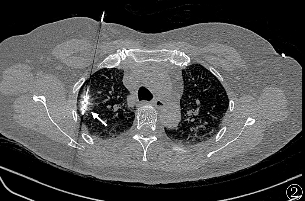微波针是什么“针芯”化结——厦门市中医院首例CT引导下肺结节微波消融_https://www.jmylbn.com_新闻资讯_第7张
