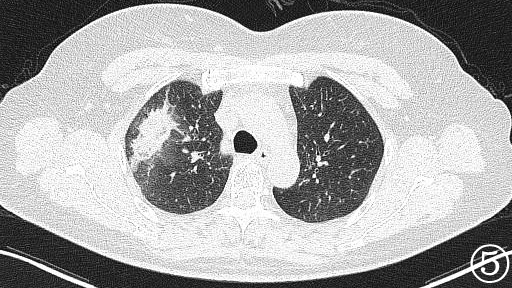 微波针是什么“针芯”化结——厦门市中医院首例CT引导下肺结节微波消融_https://www.jmylbn.com_新闻资讯_第10张