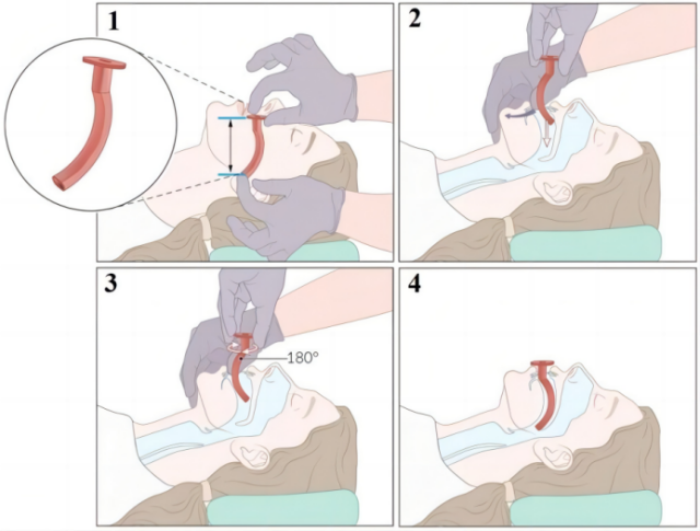 患者怎么选择人工鼻气管插管、气管切开...图解人工气道建立步骤_https://www.jmylbn.com_新闻资讯_第2张