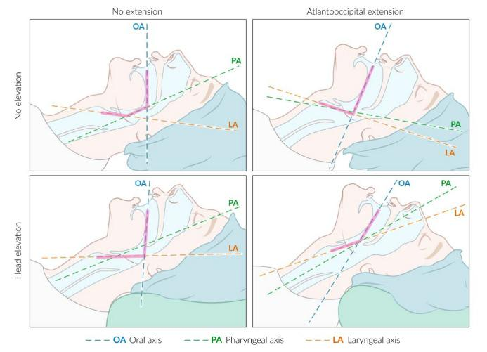 患者怎么选择人工鼻气管插管、气管切开...图解人工气道建立步骤_https://www.jmylbn.com_新闻资讯_第7张