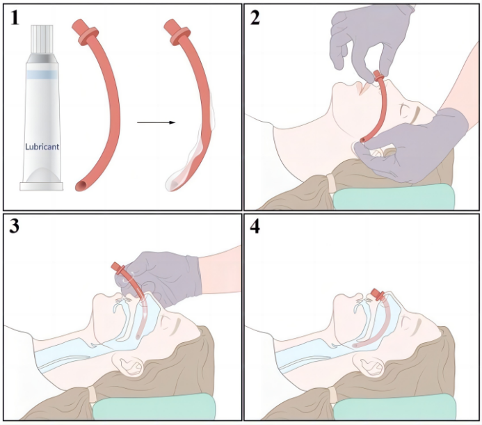 患者怎么选择人工鼻气管插管、气管切开...图解人工气道建立步骤_https://www.jmylbn.com_新闻资讯_第3张