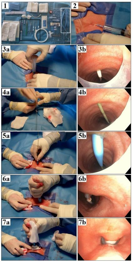 患者怎么选择人工鼻气管插管、气管切开...图解人工气道建立步骤_https://www.jmylbn.com_新闻资讯_第11张