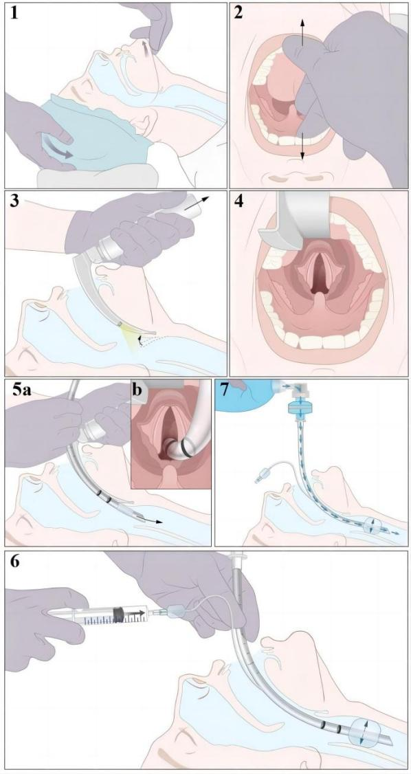 患者怎么选择人工鼻气管插管、气管切开...图解人工气道建立步骤_https://www.jmylbn.com_新闻资讯_第10张