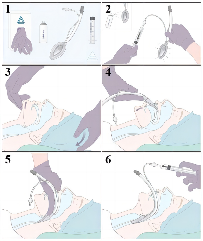 患者怎么选择人工鼻气管插管、气管切开...图解人工气道建立步骤_https://www.jmylbn.com_新闻资讯_第4张