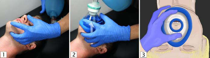 患者怎么选择人工鼻气管插管、气管切开...图解人工气道建立步骤_https://www.jmylbn.com_新闻资讯_第9张