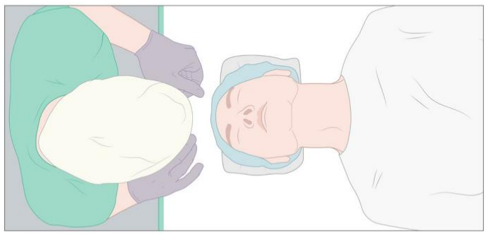 患者怎么选择人工鼻气管插管、气管切开...图解人工气道建立步骤_https://www.jmylbn.com_新闻资讯_第8张