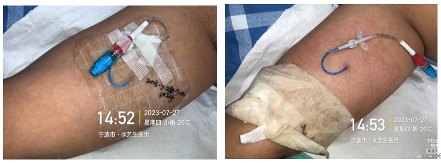 为什么用银敷每天都在换药，这些治疗性敷料你用对了吗？_https://www.jmylbn.com_新闻资讯_第6张