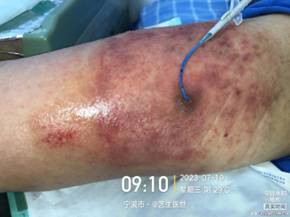 为什么用银敷每天都在换药，这些治疗性敷料你用对了吗？_https://www.jmylbn.com_新闻资讯_第16张