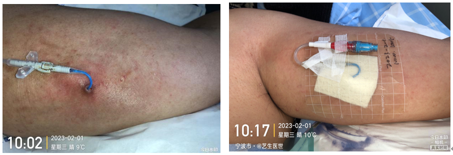 为什么用银敷每天都在换药，这些治疗性敷料你用对了吗？_https://www.jmylbn.com_新闻资讯_第7张