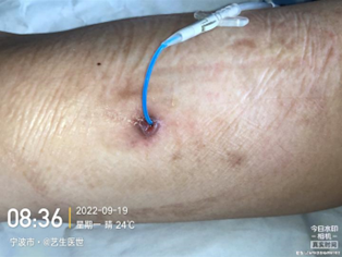 为什么用银敷每天都在换药，这些治疗性敷料你用对了吗？_https://www.jmylbn.com_新闻资讯_第11张