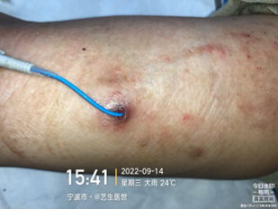 为什么用银敷每天都在换药，这些治疗性敷料你用对了吗？_https://www.jmylbn.com_新闻资讯_第8张