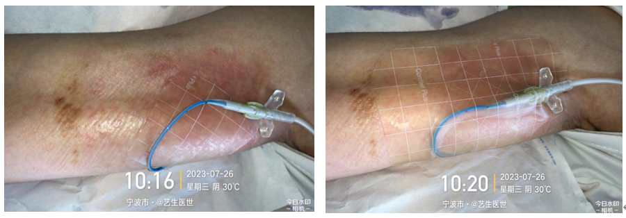 为什么用银敷每天都在换药，这些治疗性敷料你用对了吗？_https://www.jmylbn.com_新闻资讯_第4张