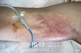 为什么用银敷每天都在换药，这些治疗性敷料你用对了吗？_https://www.jmylbn.com_新闻资讯_第3张