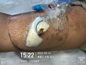 为什么用银敷每天都在换药，这些治疗性敷料你用对了吗？_https://www.jmylbn.com_新闻资讯_第12张